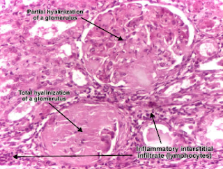 Was ist wirksame Behandlung für chronische Nephritis