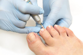 Fungal Toenail Therapy