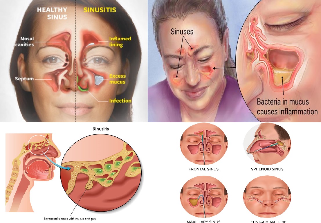  Penyakit  Sinusitis 