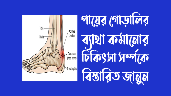 পায়ের গোড়ালির হাড় বৃদ্ধির চিকিৎসা