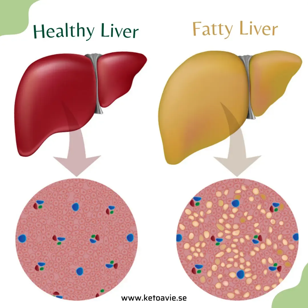 Two Liver Images: Healthy and Fatty Liver