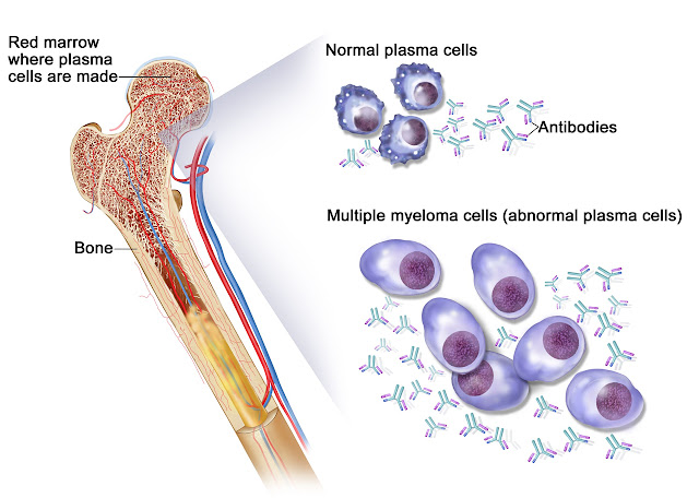 Kahler’s disease