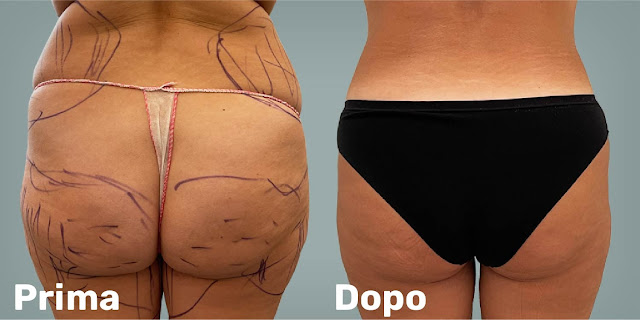 Donna di 56 anni prima e dopo la liposuzione nella zona dei glutei