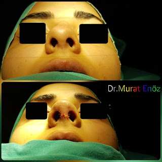 Micromotor Assisted Rhinoplasty, Nose Job Istanbul,Female Nose Aesthetic Turkey,