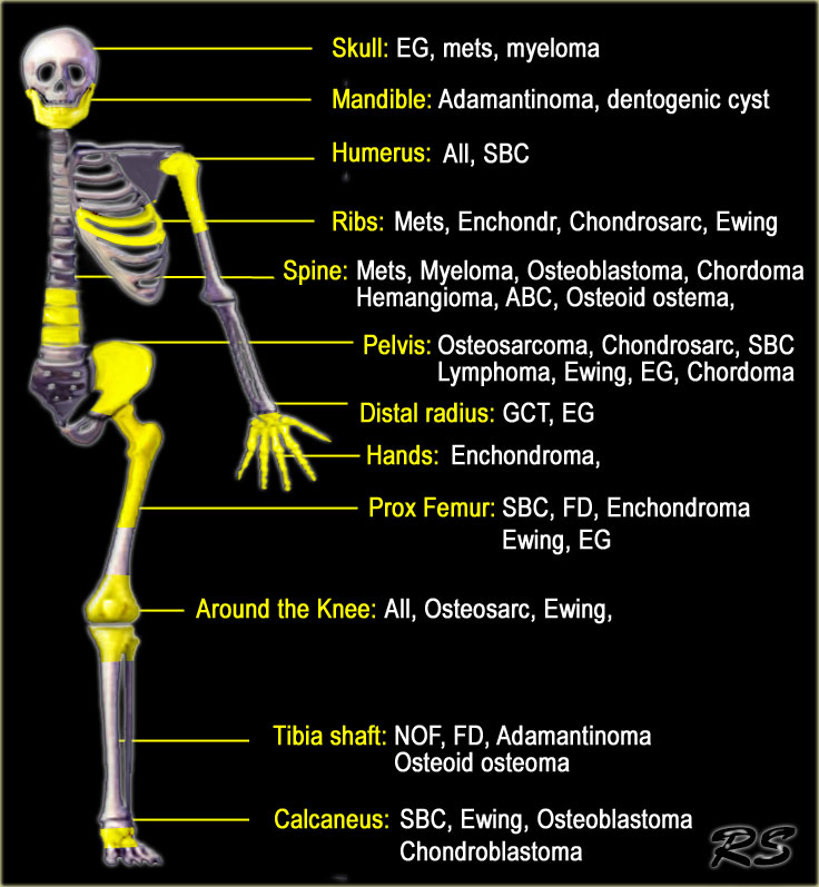 humerus bone anatomy. The location of a one lesion