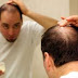 Premature hair loss and treatment | cause 