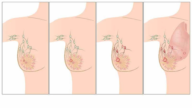 سرطان الثدي