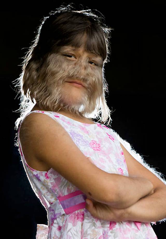 werewolf syndrome. as Werewolf Syndrome,