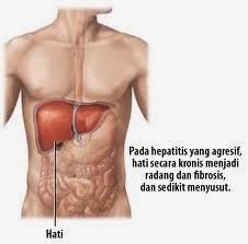 Obat Untuk Penyakit Radang Hati