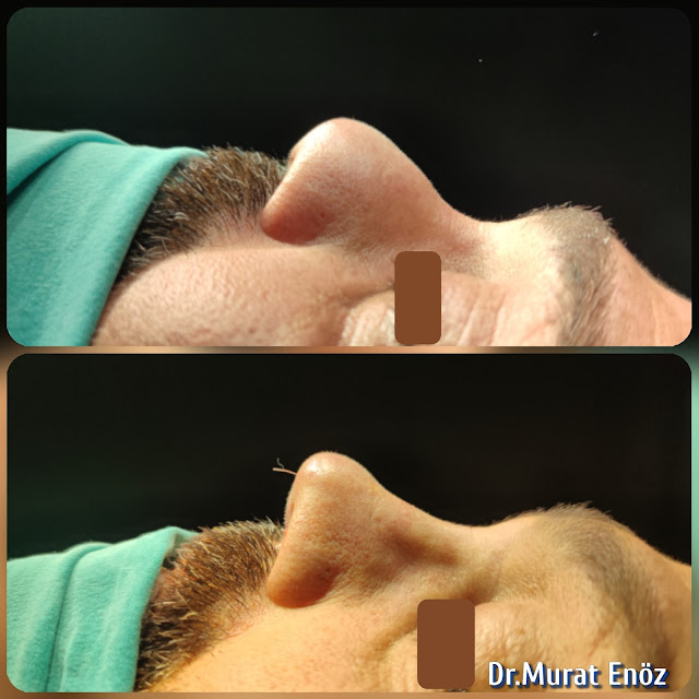Nasal septal abscess, Foreign body reaction,Complicated Revision Rhinoplasty, Nose abscess, Tissue reaction due to industrial material in the nose