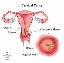 Cervical cancer