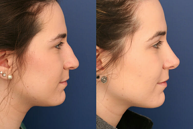 Rhinoplasty