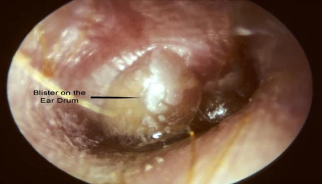 Bullous-myringitis