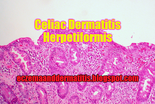 Celiac Dermatitis Herpetiformis