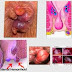 Obat Herbal Wasir Ambeven Ampuh Tanpa Operasi thumbnail
