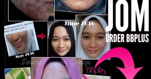 WANITA - Lakar Destinasi Kejayaan: Jerawat Alergik