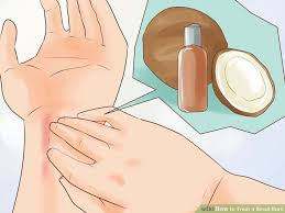 Home Remedies For Small Burns