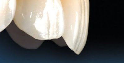 Răng toàn sứ Emax