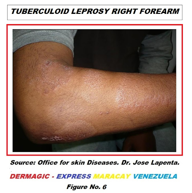 Bordeline tuberculoid leprosy, right forearm.