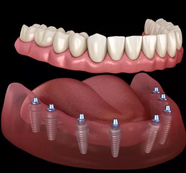 protesi dentali all on four - su otto impianti dentali
