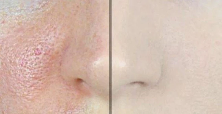 how-to-Remove-Large-Pores