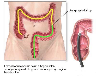 kolonoskopi