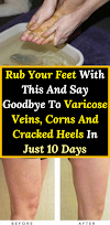 Rub Your Feet With This And Say Goodbye To Varicose Veins, Corns And Cracked Heels In Just 10 Days