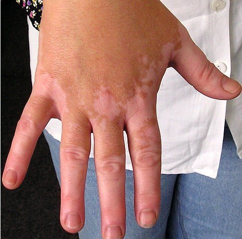 Pengobatan Penyakit  Vitiligo  Penyebab Gejala Pantangan  