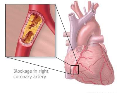  Nursing Care Plan, Care Plan for Congestive Heart Failure, Nanda