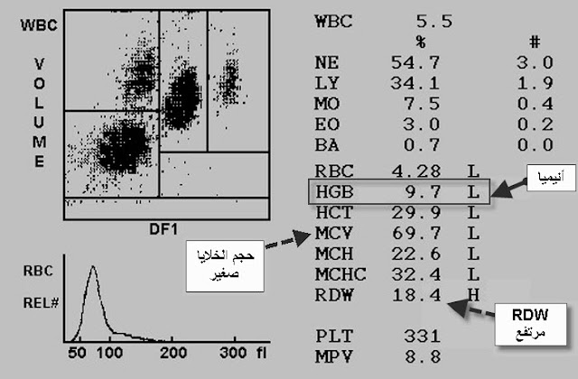 تحليل صورة دم كاملة يُظهر أنيميا نقص الحديد