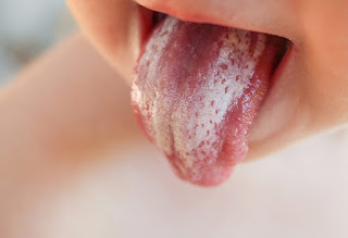 Como Curar La Candidiasis Oral