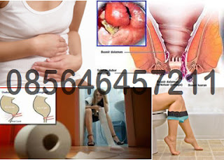 Cari Obat Wasir Hemorrhoids di Online