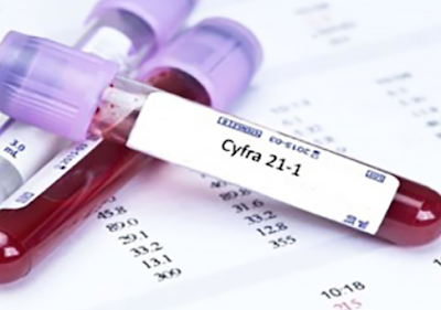  الواسم الورمي CYFRA 21-1