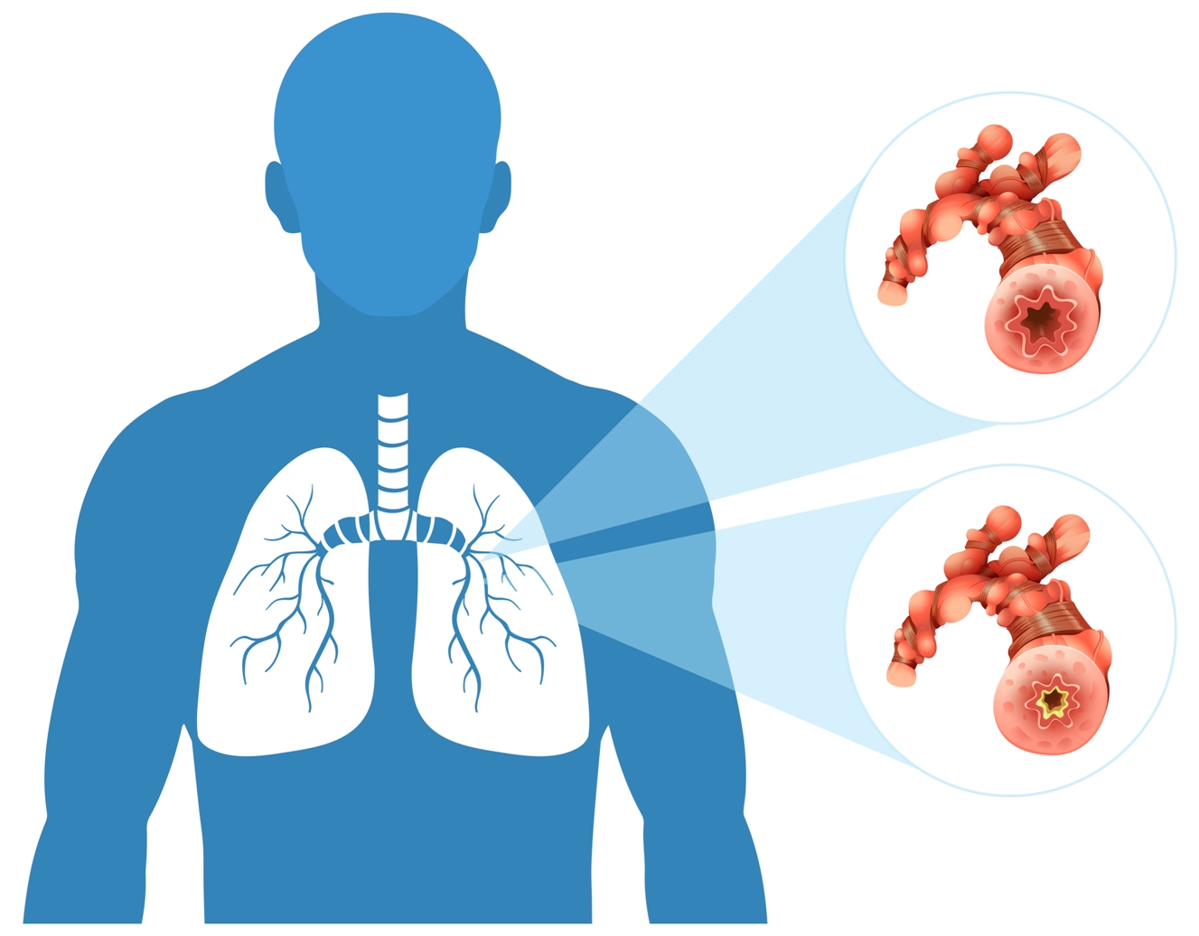 How to Prepare for Bronchoscopy Treatment?