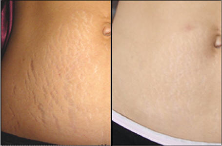 Microdermabrasion For Acne Scars Before And After Photos. solutions Scars are never