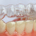 Phương pháp niềng răng hô hàm dưới không mắc cài bao lâu?