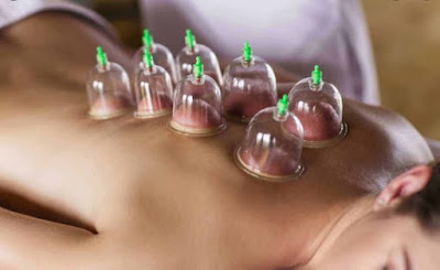 How Cupping Therapy help to improve Fertility?