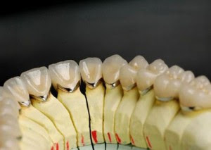 Thông tin cần biết về răng sứ titan