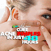 Acne, Pimple 30 Quick Home Remedies. Instant Effect in 48 Hours - Part 2