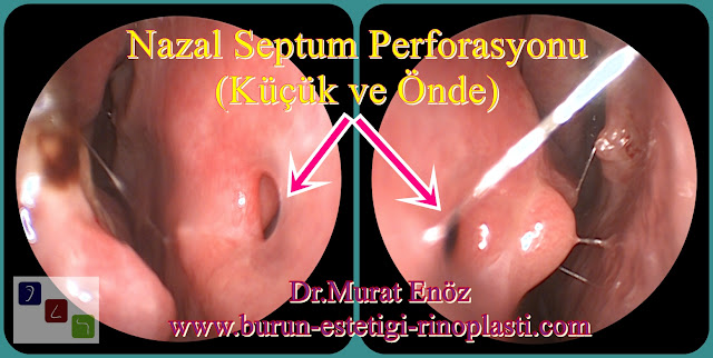 Septum perforasyonu tanımı - Septum perforasyonu  nedenleri - Septum perforasyonu belirtileri - Septum perforasyonu tedavisi - Açık teknik septum perforasyonu ameliyatı - Açık teknik septum perforasyonu onarımı - Burun duvarında delik