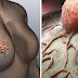 Women Must Stop Ignoring These 5 Signs of Breast Cancer