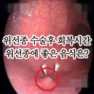 위선종 수술 후 좋은 음식에 대해서 알아보기 클릭