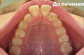 Разъехавшиеся зубы окклюзионный снимок