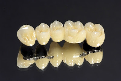 Ưu điểm của bọc răng sứ titan bạn nên biết 1