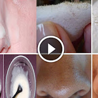 How To Prevent Blackheads Very Fast With Cheap Ingredients!