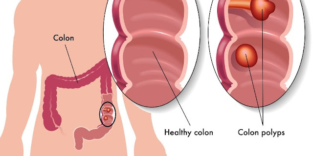 Gejala dan Penyebab Kanker Usus Besar
