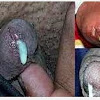 Obat keluar nanah pada kemaluan pria