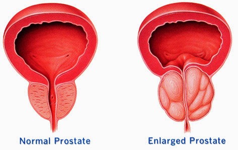 obat tradisional tumor Prostat, obat kanker prostat, pengobatan kanker prostat