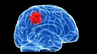 Treating Brain Tumor by Scorpion Venom