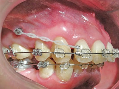 Bọc răng sứ cho răng vẩu theo quy trình chuẩn